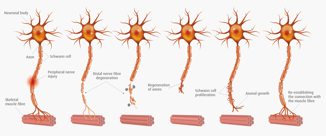 Neuropathy recovery