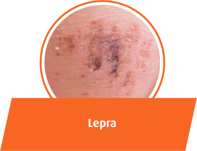 Lepra